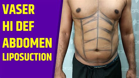 Six Pack Abs Surgery Under General Anesthesia Vaser Hi Def