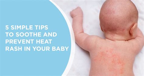 Heat Rash Baby Tips And Products For Heat Rash Prevention