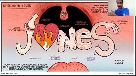 Revised Jones Criteria For Acute Rheumatic Fever Youtube