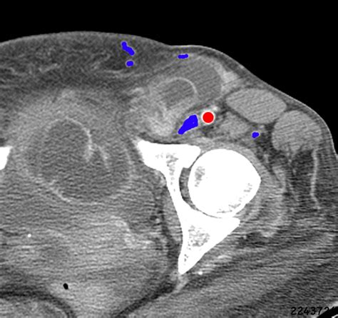 Diagnosis Of Inguinal Region Hernias With Axial Ct The Lateral