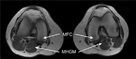 How often can an mri of the knee be performed? Axial MRI images of the popliteal region of the knee. The ...