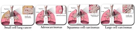 Lung Cancer Types Of Lung Cancer Kimaja Farwani