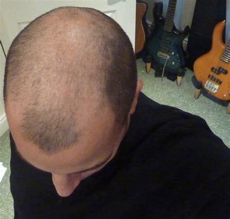 Hair Head Shaved Transplant New Porno
