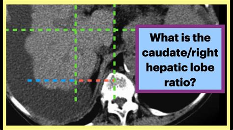 Caudate Right Hepatic Lobe Ratio Radiology Liver Gastroenterology Youtube