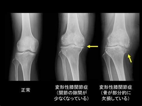 変形性膝関節症の様々な手術方法について｜人工関節の広場 ...