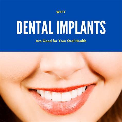 Why Dental Implants Are Good For Your Oral Health Birch Point Dental