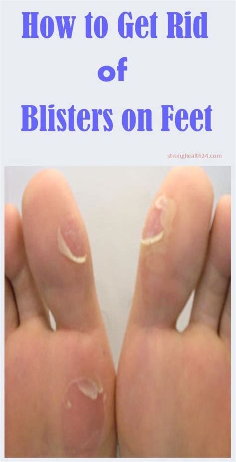How To Get Rid Of Blisters On Feet Naturally Beauty4everything3
