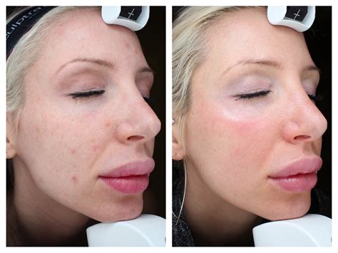 Halo Skin Treatment Before And After Your Magazine Lite