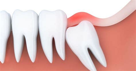 To sleep after a wisdom teeth removal surgery is certainly not an easy task. Wisdom Tooth Removal - Sleep Dentistry Melbourne