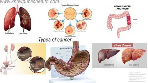Types Of Cancer Know Public Health