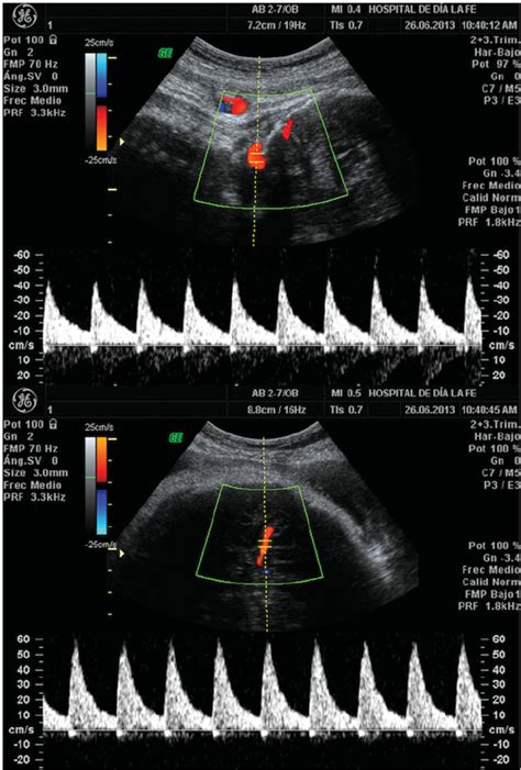 Arterial Doppler Ultrasound