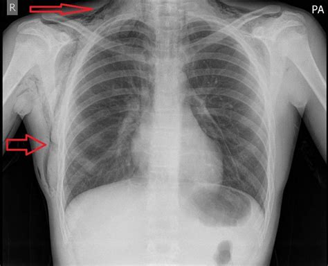 Subcutaneous Emphysema X Ray