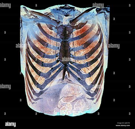 Healthy Rib Cage Ct Scan Stock Photo Alamy