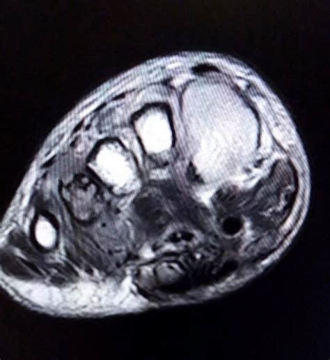 While it may be a little uncomfortable, the good news is that. Madura Foot: MRI - Sumer's Radiology Blog