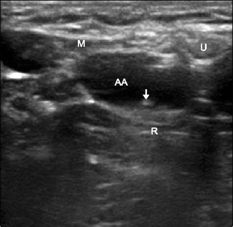 Figure 1 From Ultrasound Guided Continuous Axillary Brachial Plexus