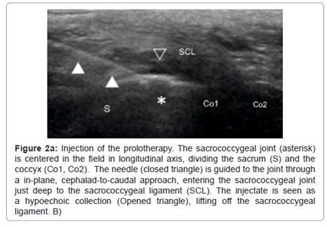 Ultrasound Guided Dextrose Prolotherapy For Persistent Coccygeal Pain