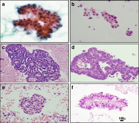 Cytomorphology Of Six Ascitic Samples Showing Ovarian Cancer Cell
