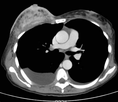 The value of preoperative staging chest computed tomography to detect asymptomatic lung and liver metastasis in patients with primary breast carcinoma. Inflammatory breast cancer | BMJ Case Reports