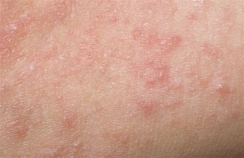 4 Things I Wish My Patients Knew About Psoriasis