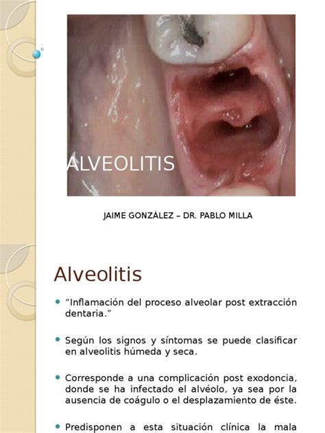 Alveolitis 130527180045 Phpapp02 Pdf Especialidades Medicas Enfermedades Y Trastornos