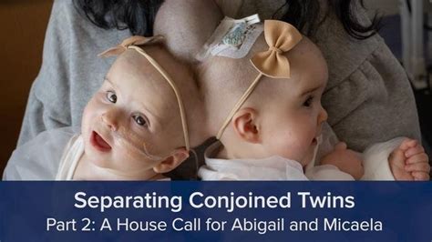 Separating Conjoined Twins Part 2 A House Call For Abigail