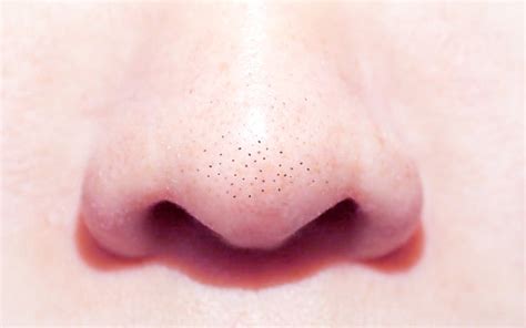 Comedonal Acne: What, Why & Ways To Treat Them – SkinKraft
