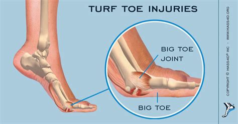 What Are Turf Toe Injuries Mass4d Insoles Mass4d Foot Orthotics