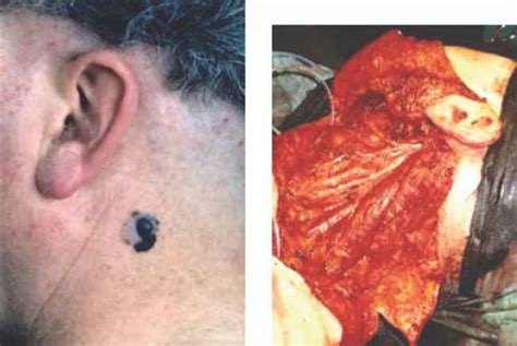 What Are The Scars Like From Total Lymph Node Removal On The Neck