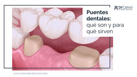 Puentes Dentales Qu Son Y Para Qu Sirven Cl Nica Doctor Calvo