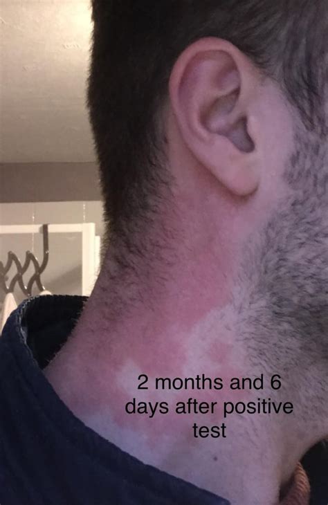Ive Had This Rash For 3 Months Now After Testing Positive For Covid