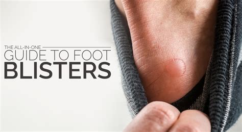 The All In One Guide To Foot Blisters Positive Health Wellness