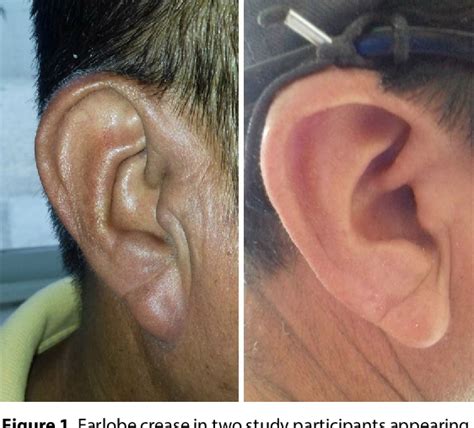 Figure 1 From Intracranial Atherosclerosis And The Earlobe Crease