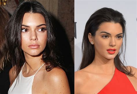 Kendall Jenner Nose Job Plastic Surgery Before And After Photos