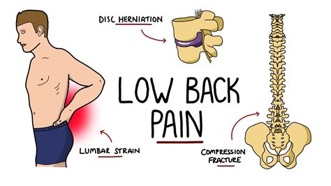 Low Back Pain Explained Including Red Flags Youtube