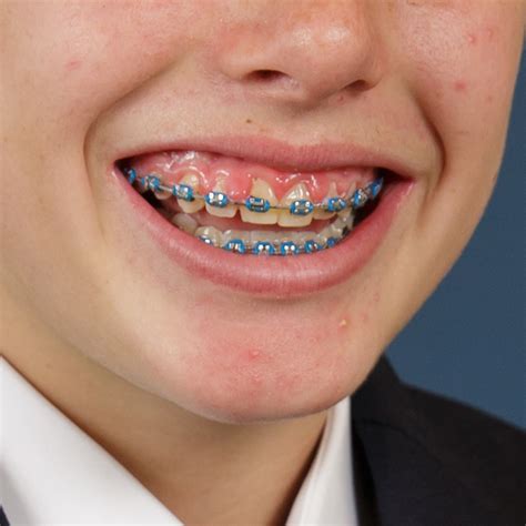 swollen gums with braces caption simple
