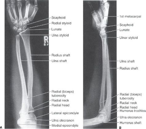 Forearm X Ray Labeled