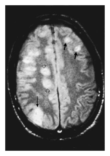 Neurologic Complications Of The Reactivation Of Varicellazoster Virus
