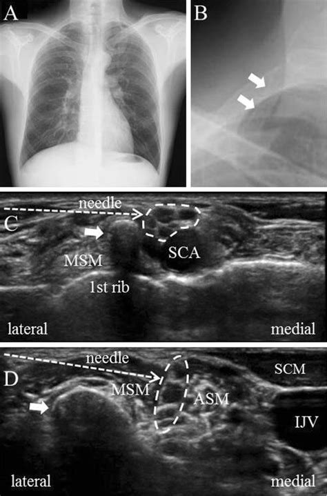 Ultrasound Guided Supraclavicular Brachial Plexus Block In A Patient