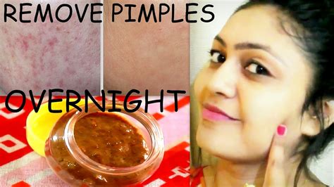 remove pimples overnight 100 success सिर्फ 1 दिन में पाए मुहांसे से छुटकारा acne