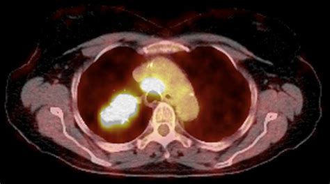 Lung Cancer Ct And Pet Scans Photograph By Du Cane Medical Imaging Ltd