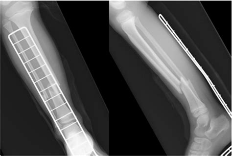 Figure 1 From Open Tibial Shaft Fracture In A Boy With Autism Spectrum