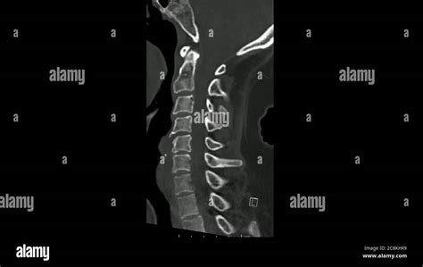 Computed Tomography Examination Of The Cervical Spine Ct Cs Sagittal