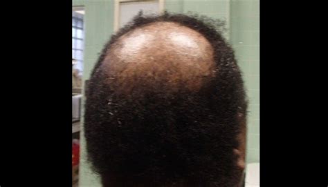 Derm Dx Mid Scalp Alopecia In A Woman Clinical Advisor