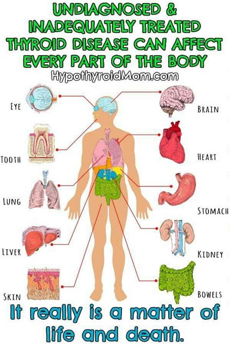 Hypothyroidism, which refers to an underactive thyroid, is when insufficient. Pin by Lisa Hill on Hypothyroid | Hypothyroidism symptoms ...