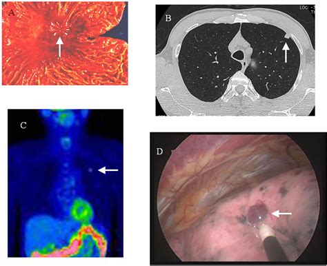 Pulmonary Metastasis From Gastric Cancer A Case Report And Review Of