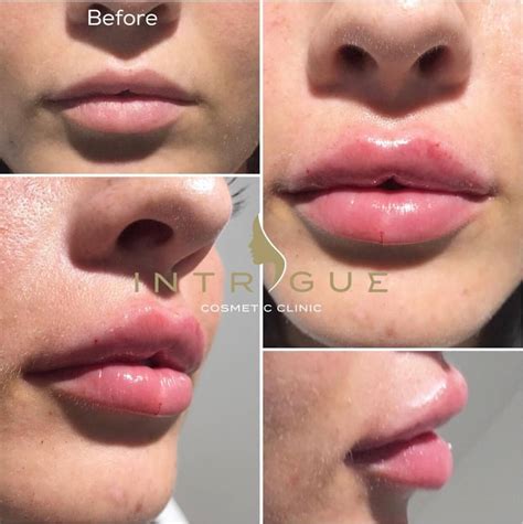 2ml Lip Fillers Before And After