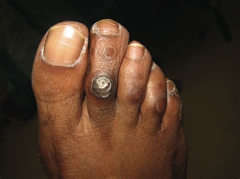 Prophylactic Foot Surgery In Patients With Diabetes Is It Worth The Risk