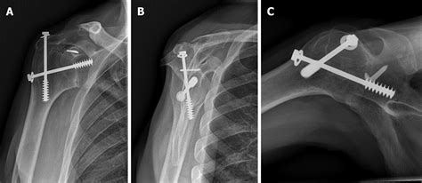Conversion To Reverse Shoulder Arthroplasty Fifty One Years After