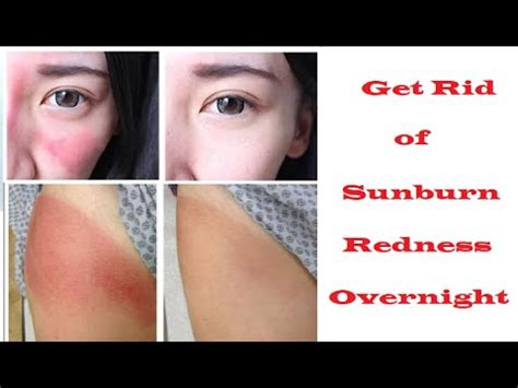 How to Get Rid of Sunburn Redness Overnight 
