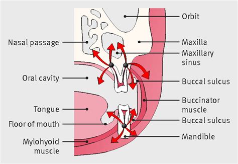 Management Of Severe Acute Dental Infections The Bmj